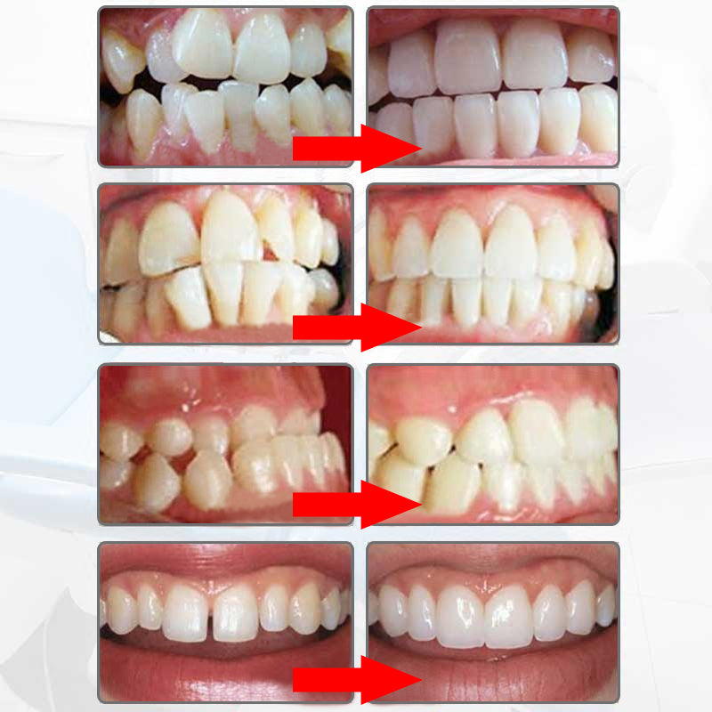 Tooth Alignment Tool
