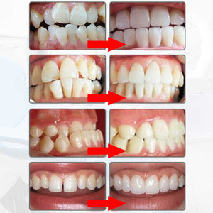 Tooth Alignment Tool